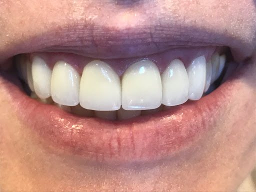 photo of restored and whitened teeth after treatment; teeth are evenly spaced and look natural