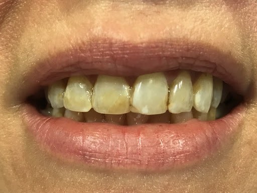 photo of dull and damaged teeth before treatment